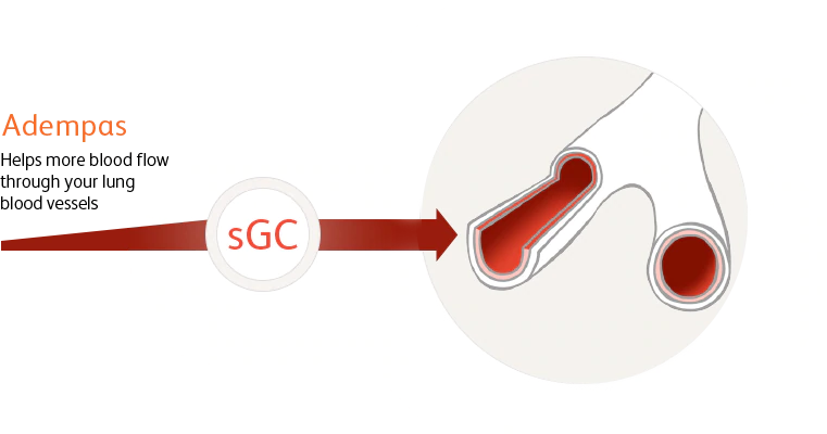 Graphic showing how Adempas helps blood flow through lung blood vessels by stimulating sGC.
