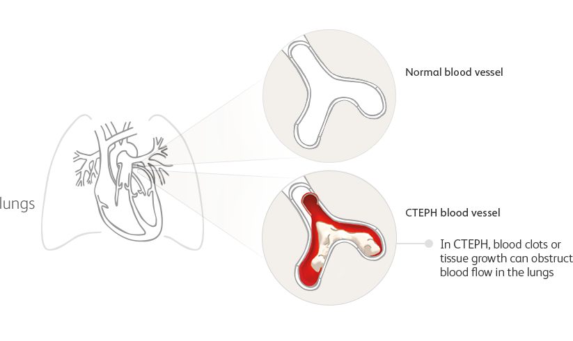 Illustration showing a normal lung blood vessel and a blood vessel affected by CTEPH