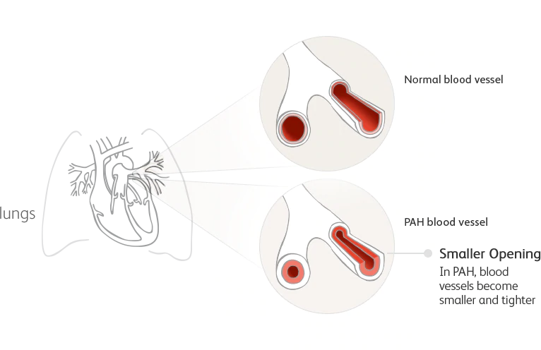 Illustration showing a normal lung blood vessel and a blood vessel affected by PAH